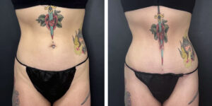 before and after tummy tuck front view female patient case 918