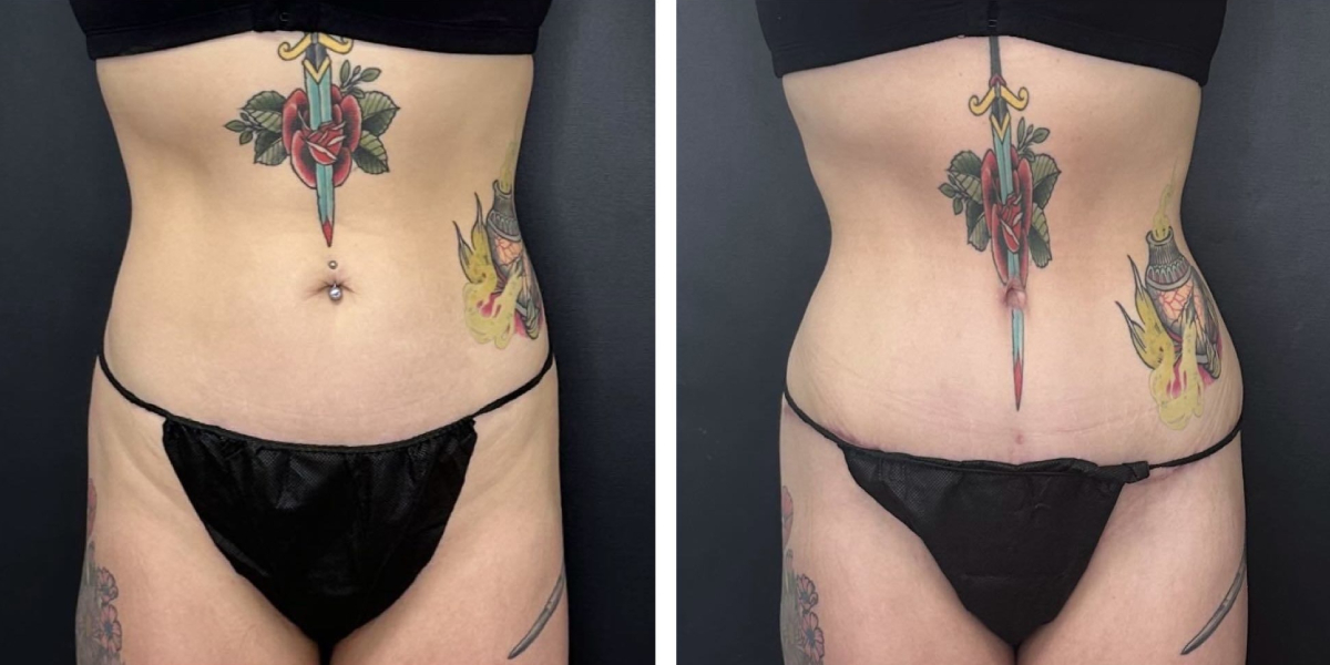 before and after tummy tuck front view female patient case 918