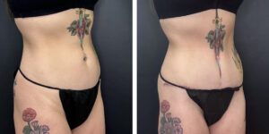 before and after tummy tuck right angle view female patient case 918