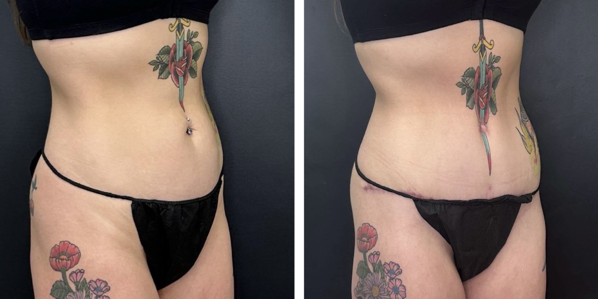before and after tummy tuck right angle view female patient case 918