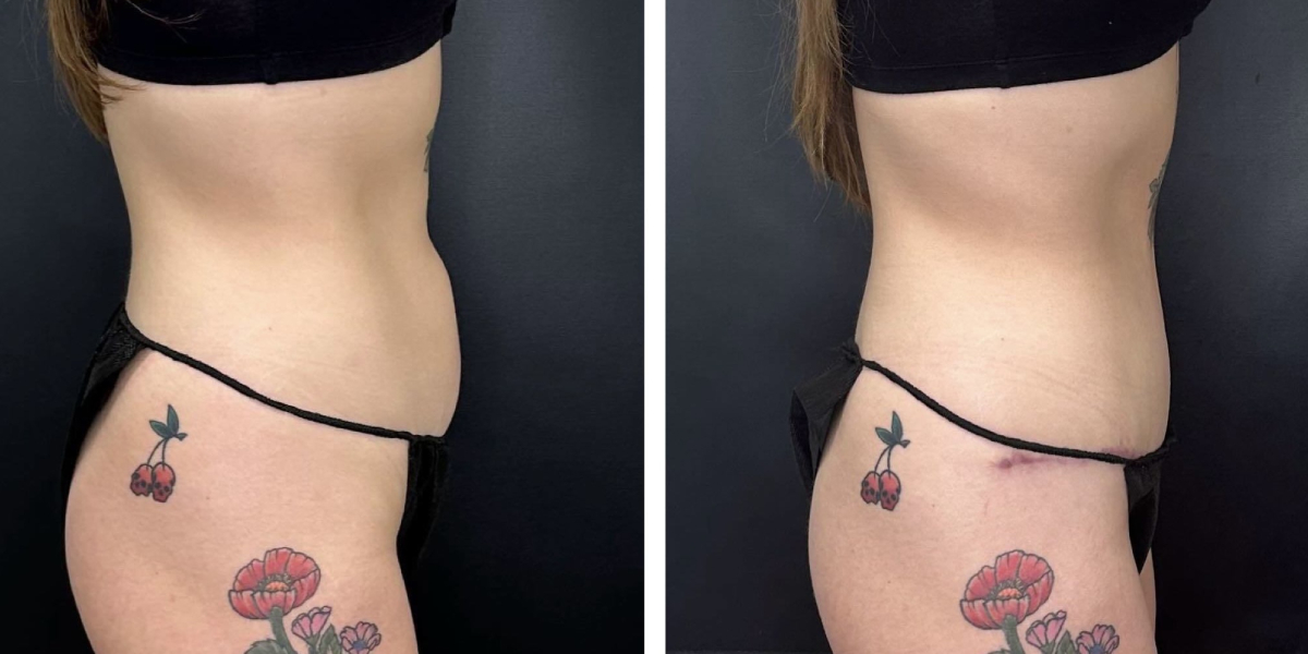 before and after tummy tuck right side view female patient case 918