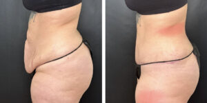 before and after tummy tuck left side view female patient case 924