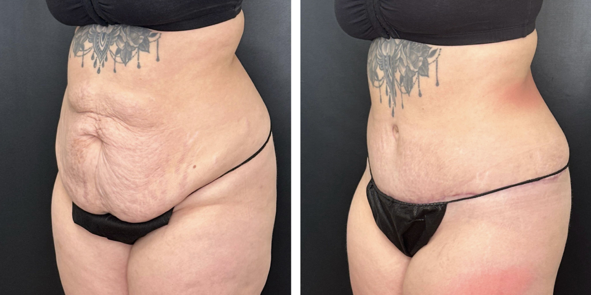 before and after tummy tuck left angle view female patient case 924