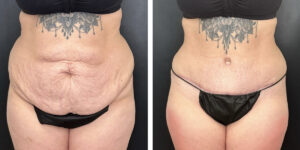 before and after tummy tuck front view female patient case 924