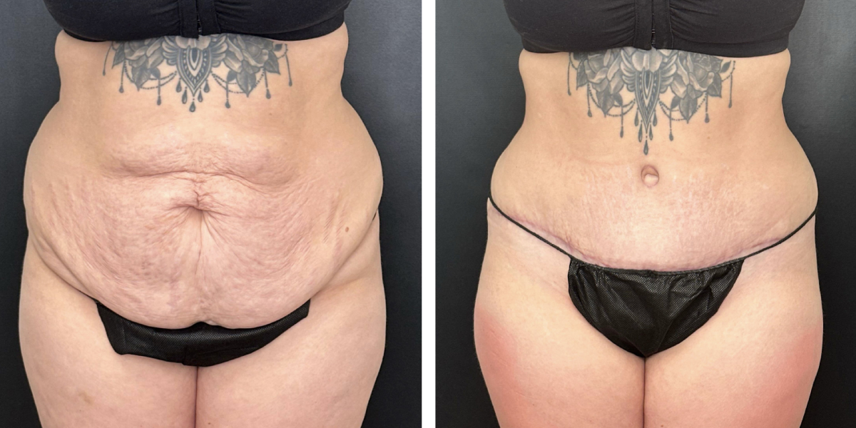 before and after tummy tuck front view female patient case 924