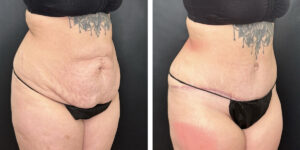 before and after tummy tuck right angle view female patient case 924