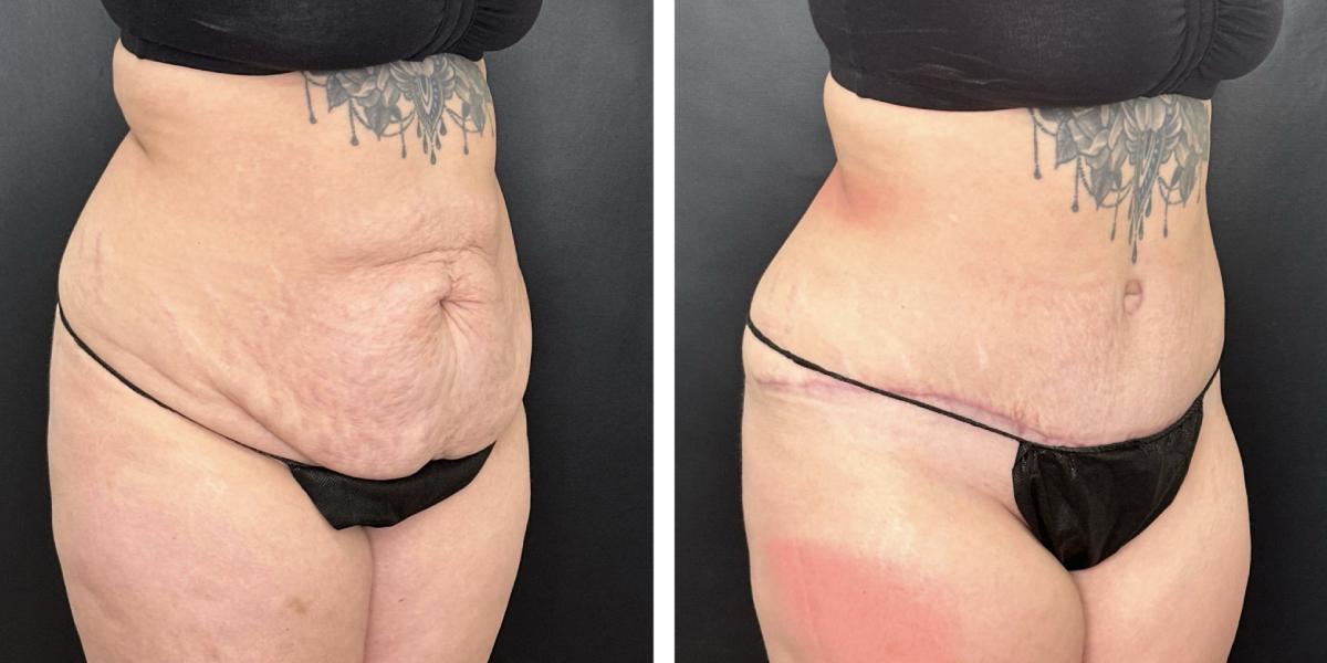 before and after tummy tuck right angle view female patient case 924