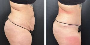 before and after tummy tuck right side view female patient case 924