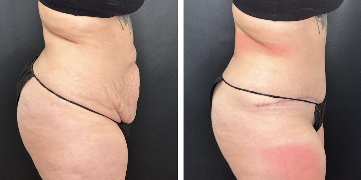 before and after tummy tuck right side view female patient case 924
