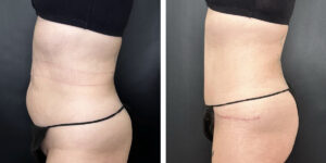 before and after tummy tuck left side view female patient case 930