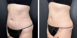 before and after tummy tuck left angle view female patient case 930