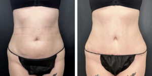 before and after tummy tuck front view female patient case 930