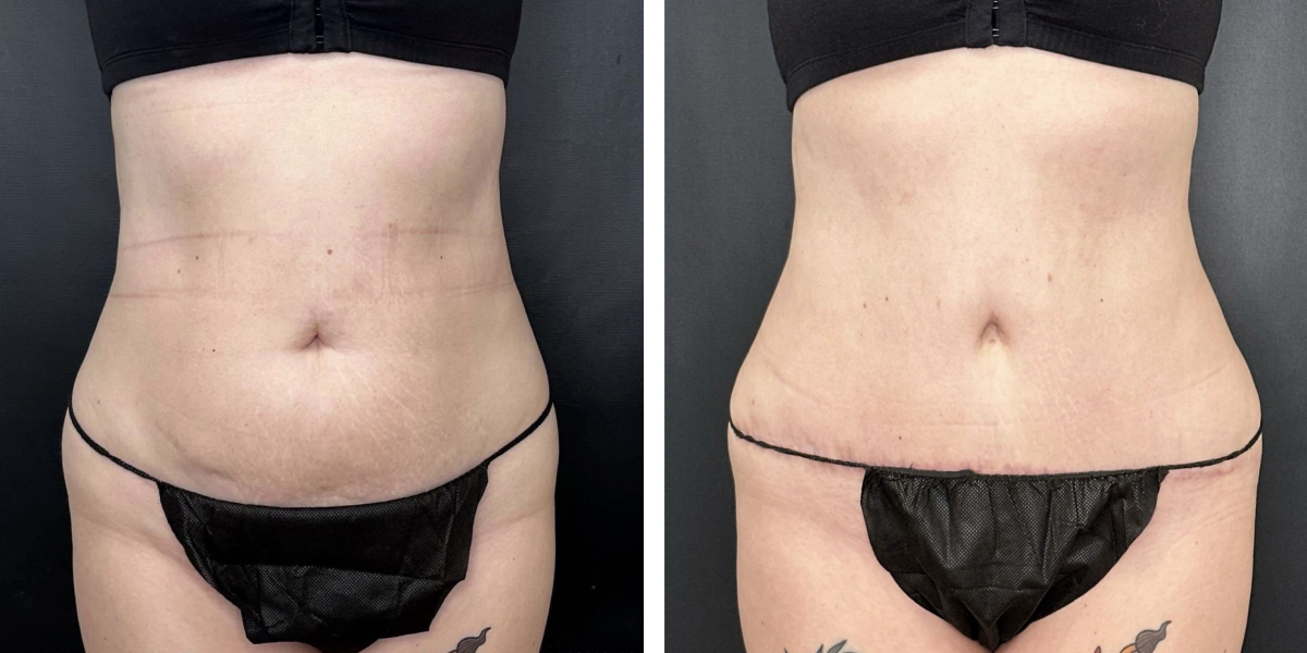 before and after tummy tuck front view female patient case 930