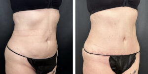 before and after tummy tuck right angle view female patient case 930