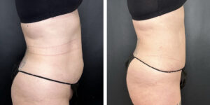 before and after tummy tuck right side view female patient case 930