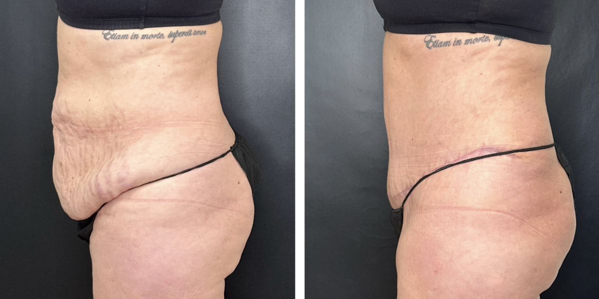before and after tummy tuck left side view female patient case 936