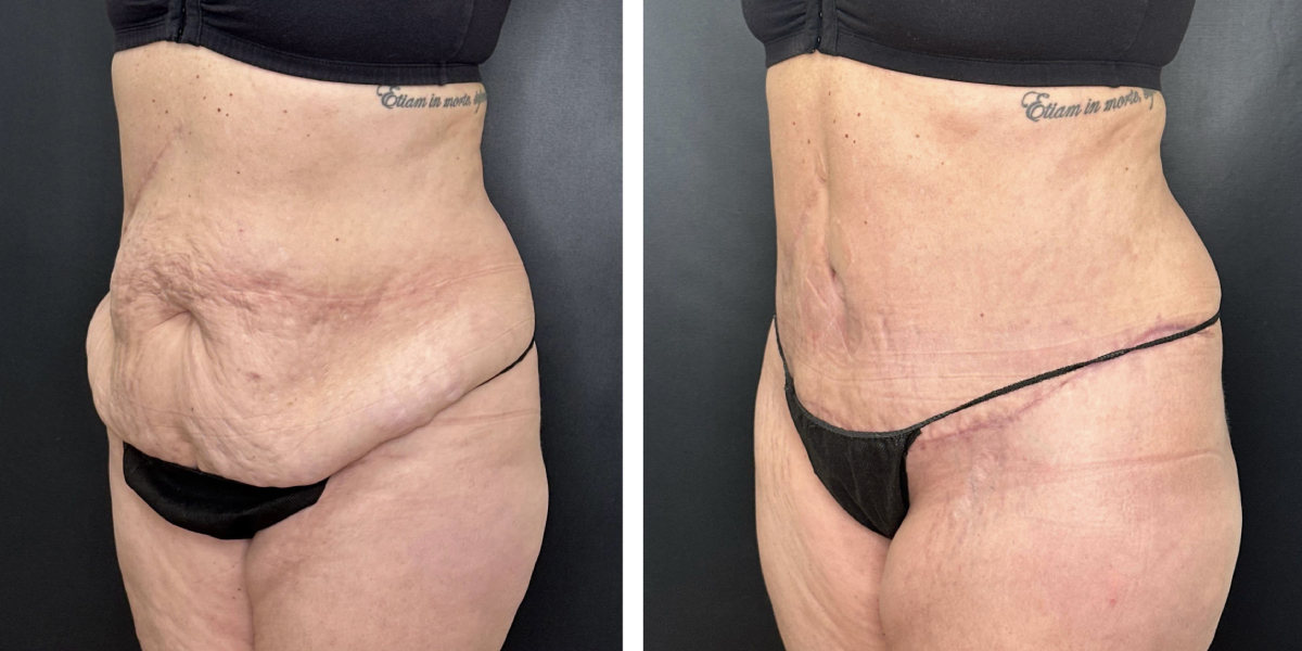 before and after tummy tuck left angled view female patient case 936