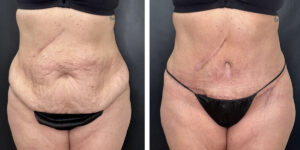 before and after tummy tuck front view female patient case 936