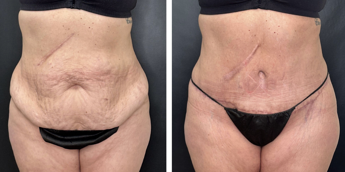 before and after tummy tuck front view female patient case 936