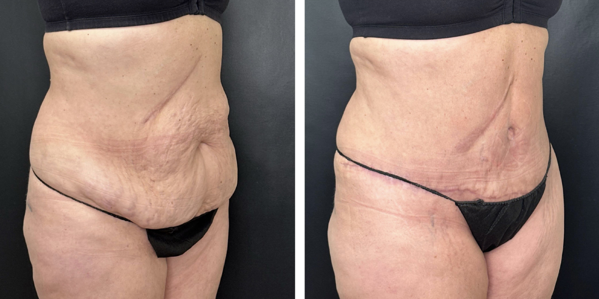 before and after tummy tuck right angled view female patient case 936