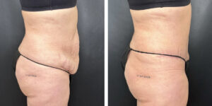 before and after tummy tuck right side view female patient case 936