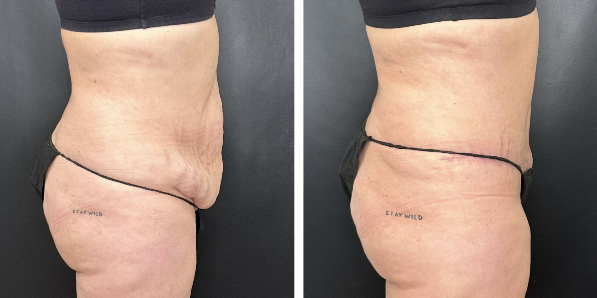 before and after tummy tuck right side view female patient case 936