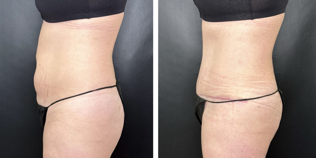 before and after tummy tuck left side view female patient case 942