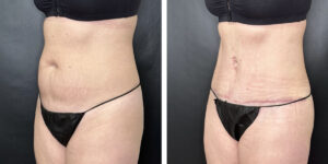 before and after tummy tuck left angled view female patient case 942