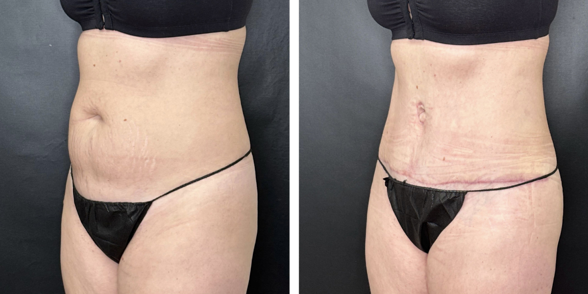 before and after tummy tuck left angled view female patient case 942