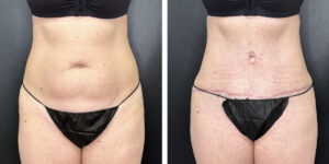 before and after tummy tuck front view female patient case 942