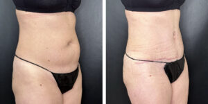 before and after tummy tuck right angled view female patient case 942