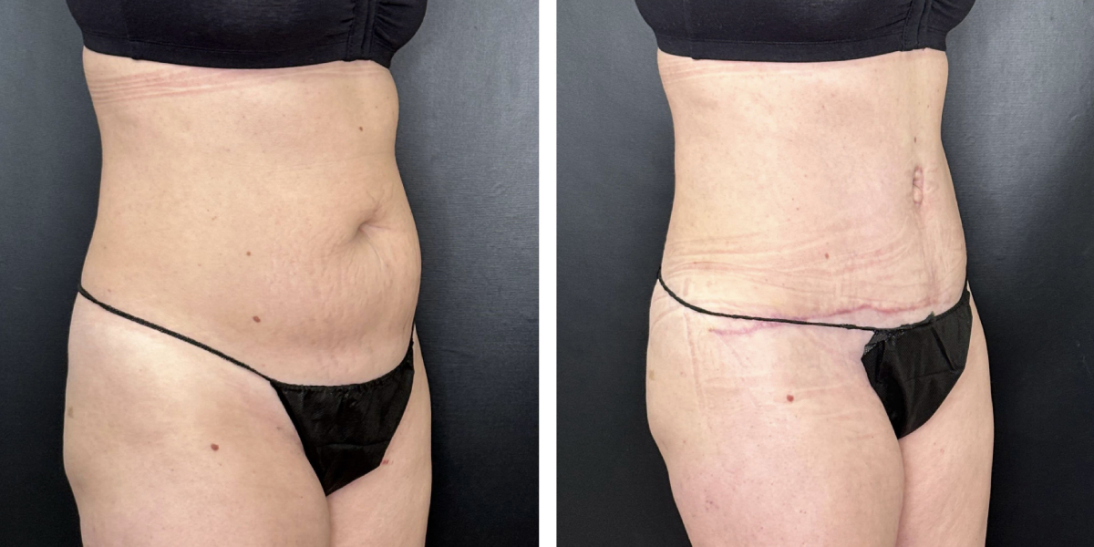before and after tummy tuck right angled view female patient case 942