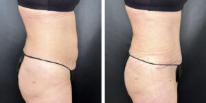 before and after tummy tuck right side view female patient case 942