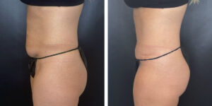 before and after tummy tuck left side view female patient case 948