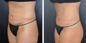 before and after tummy tuck left angled view female patient case 948