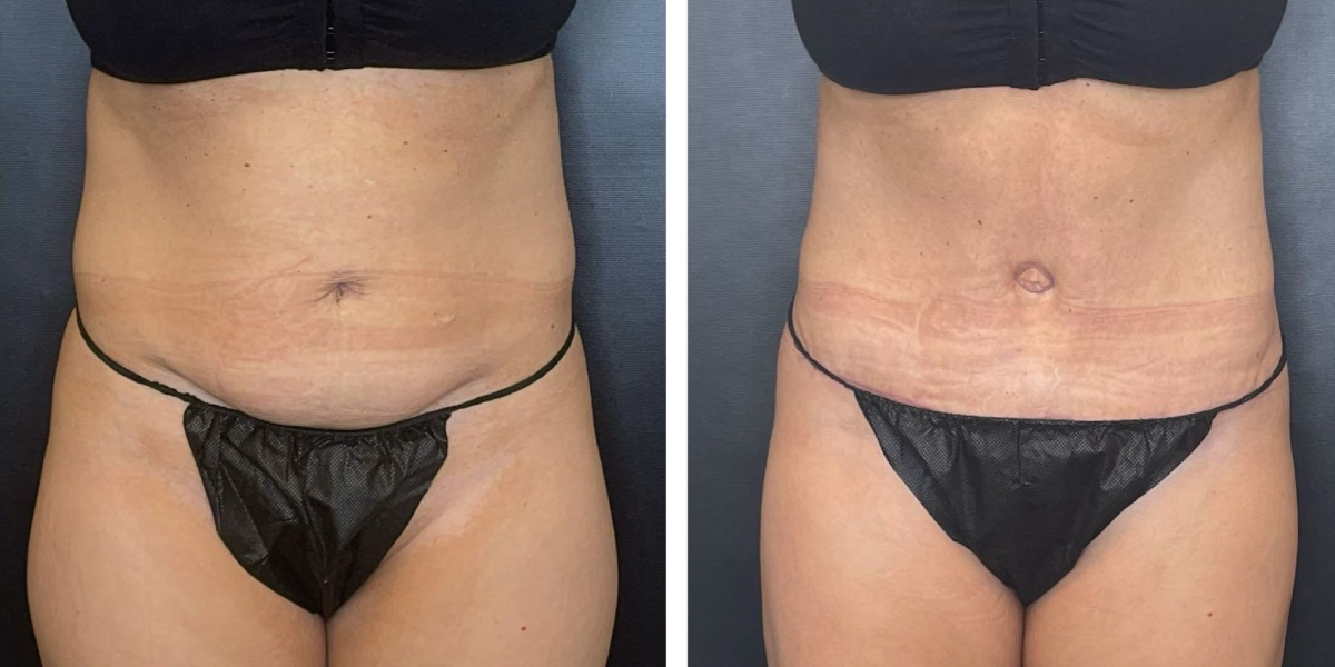 before and after tummy tuck front view female patient case 948