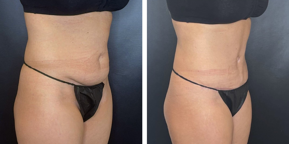 before and after tummy tuck right angled view female patient case 948