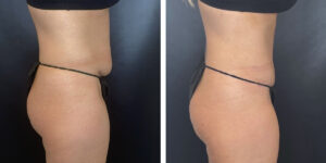 before and after tummy tuck right side view female patient case 948