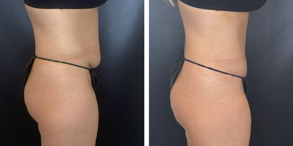 before and after tummy tuck right side view female patient case 948
