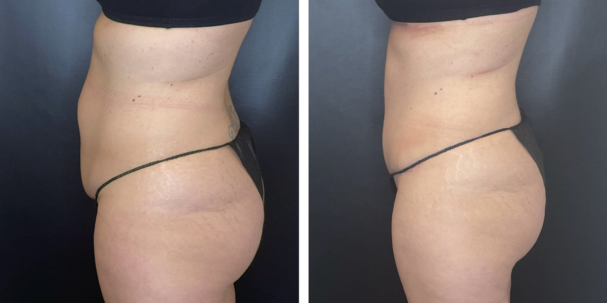 before and after tummy tuck left side view female patient case 954