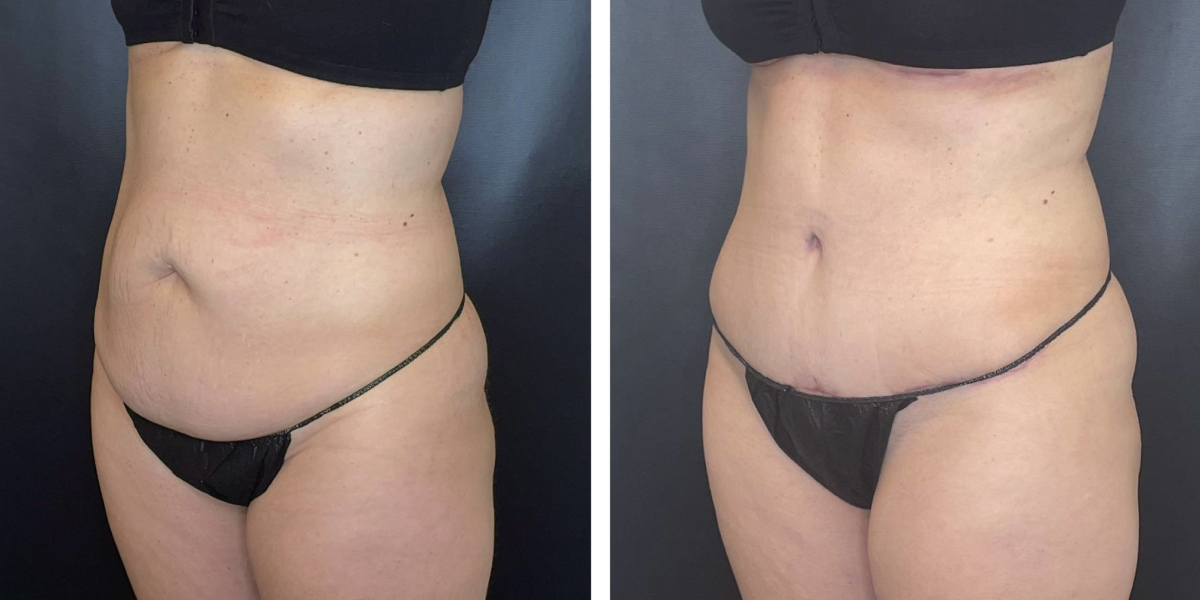 before and after tummy tuck left angled view female patient case 954