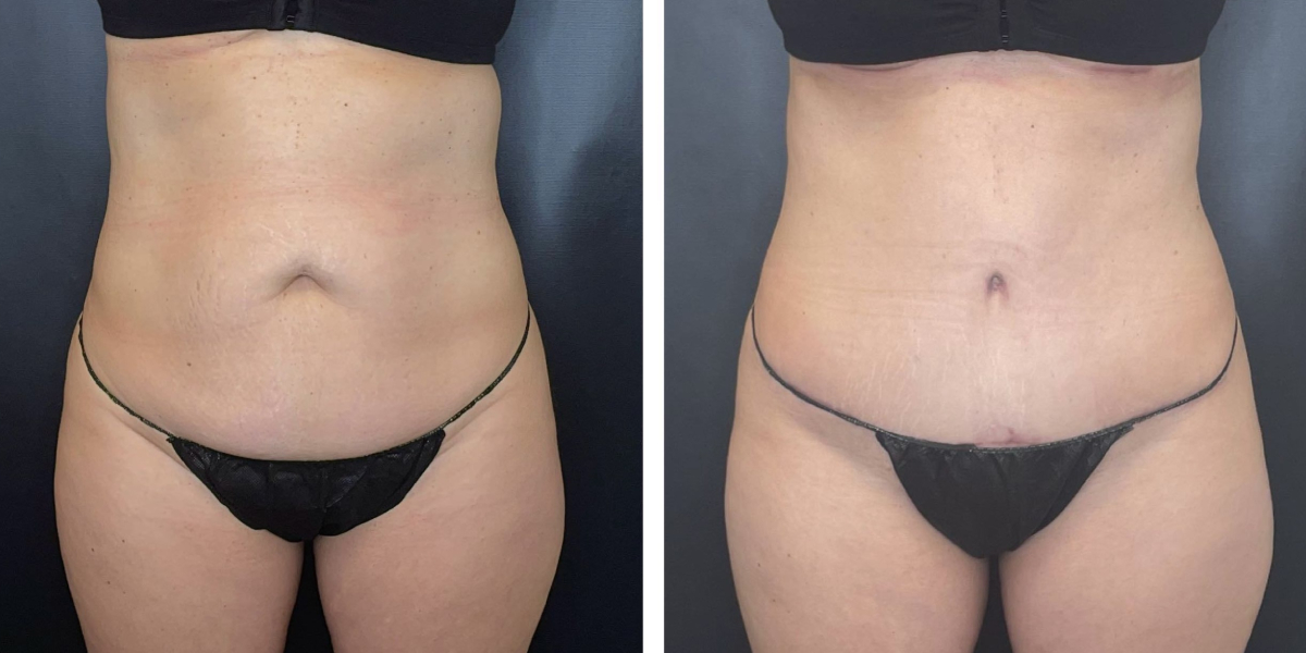 before and after tummy tuck front view female patient case 954