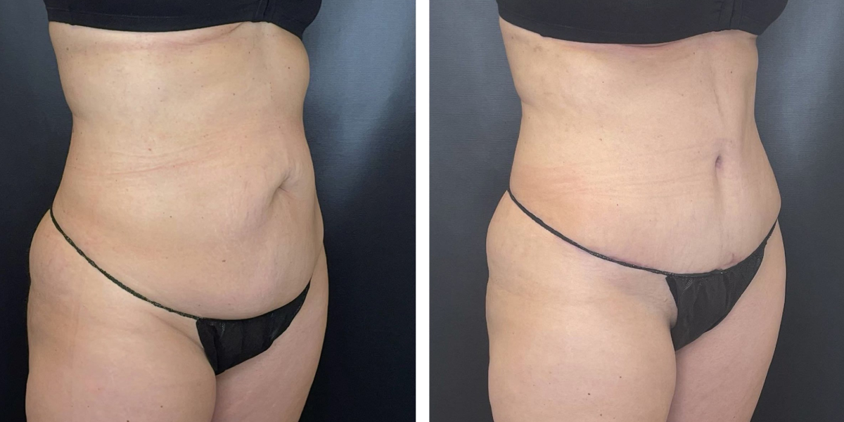 before and after tummy tuck right angled view female patient case 954