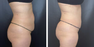 before and after tummy tuck right side view female patient case 954