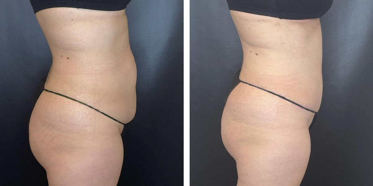 before and after tummy tuck right side view female patient case 954