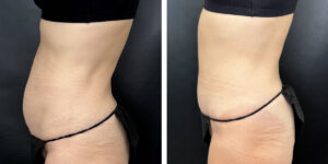 before and after tummy tuck left side view female patient case 960