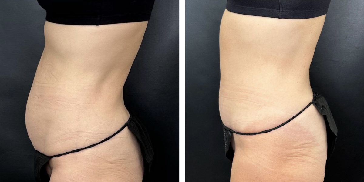 before and after tummy tuck left side view female patient case 960