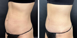 before and after tummy tuck left angled view female patient case 960