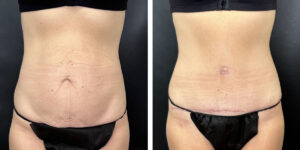 before and after tummy tuck front view female patient case 960