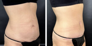 before and after tummy tuck right angled view female patient case 960